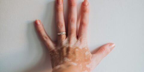 Unmoderated Task – Vitiligo (Nationwide) – Earn $75 a woman's hand with a lot of cream on it